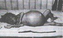 Choledochal cysta