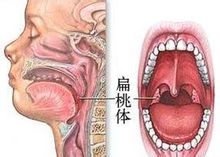 Tonsillhypertrofi