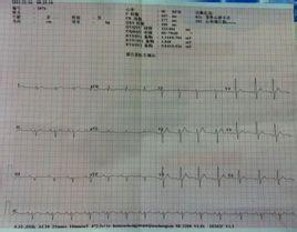 EKG vänster axel avvikelse