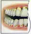 Gingival recession