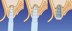 Maxillary sinus augmentation