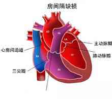 Medfödd hjärtsjukdom