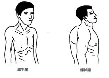 Thoracic deformitet