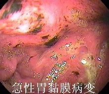 Akuta gastric slemhinnelesioner